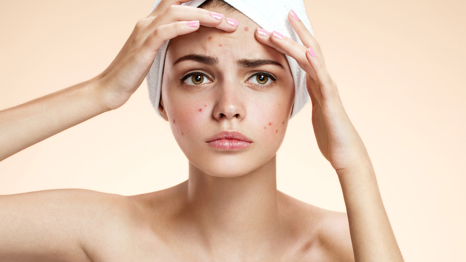 remedios caseros acné